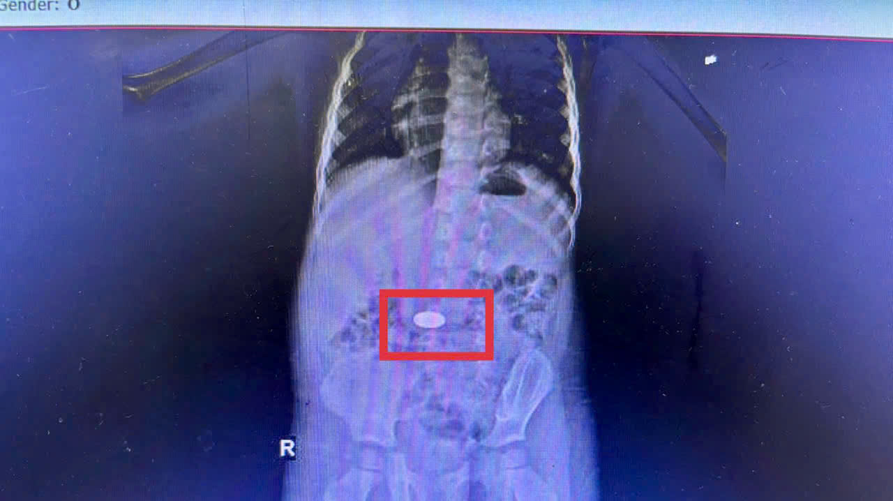 Khánh Hòa: Liên tiếp 5 trẻ nuốt đồng xu trong một tháng – Cảnh báo phụ huynh không được chủ quan